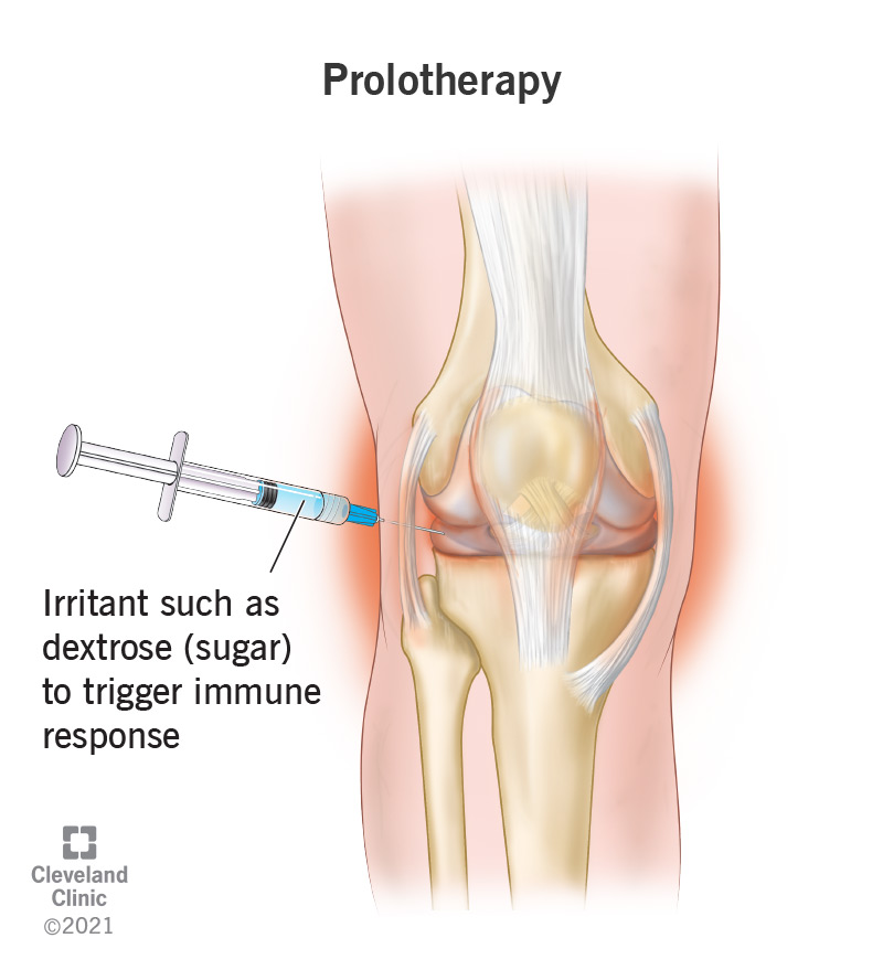 A prolotherapy treatment is injected into a knee.