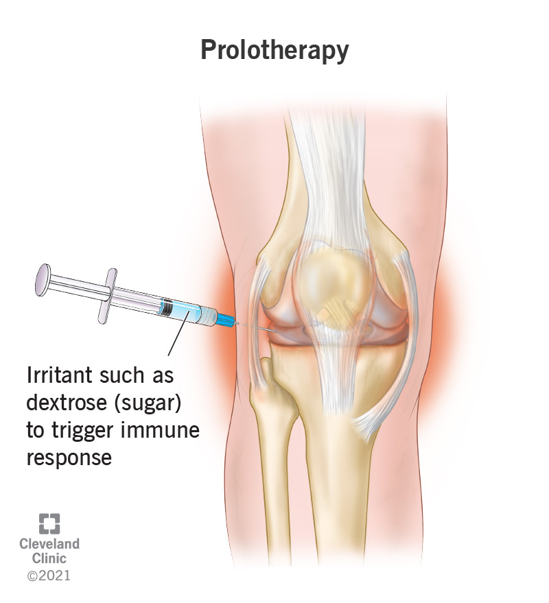 Prolotherapy - Low Back Pain and Sciatica