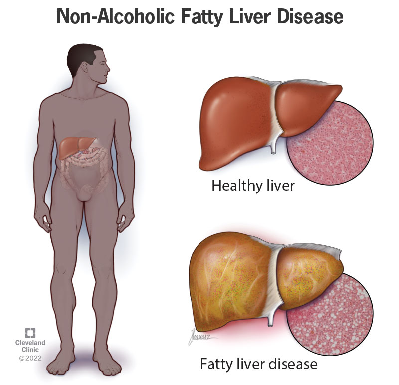 A healthy liver and a fatty liver.