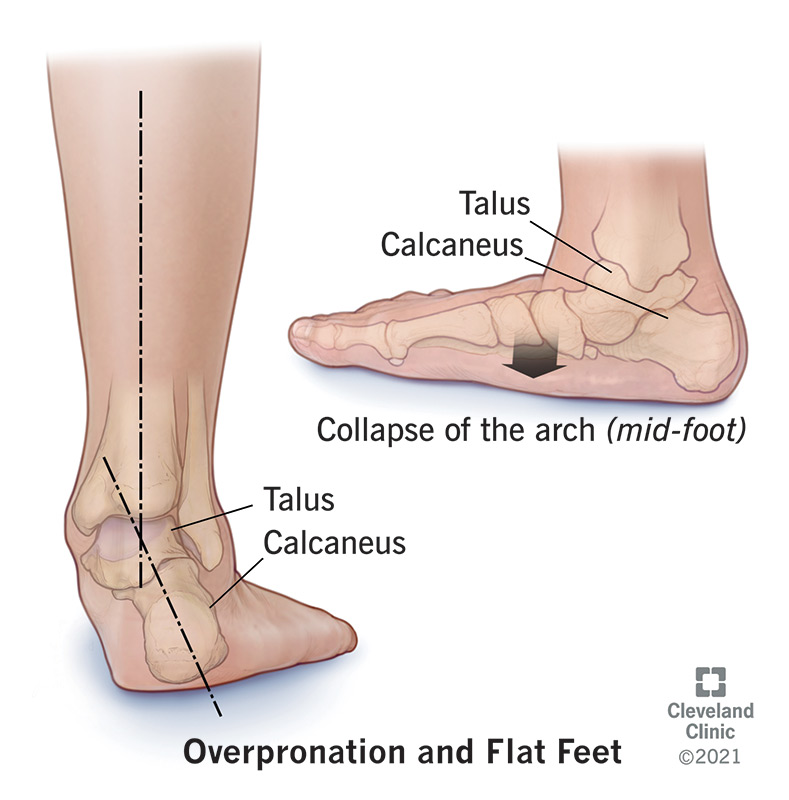 Supination and 2024 flat feet