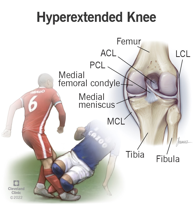 Labeled anatomy of the knee and an illustration of a hyperextended knee during a soccer game