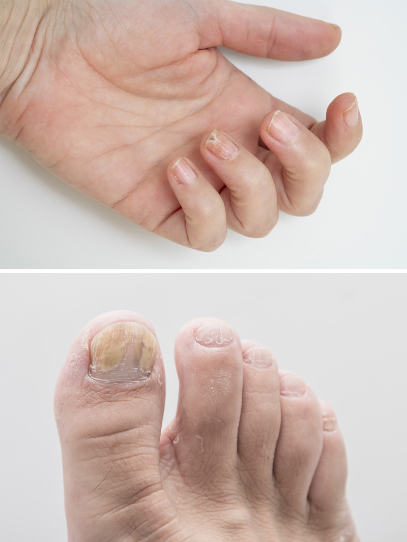 Dystrophic nails on a hand and foot