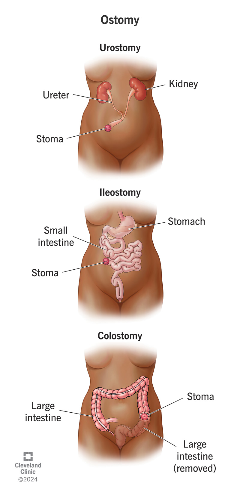 Comparison between ostomy types: urostomy, ileostomy and colostomy.