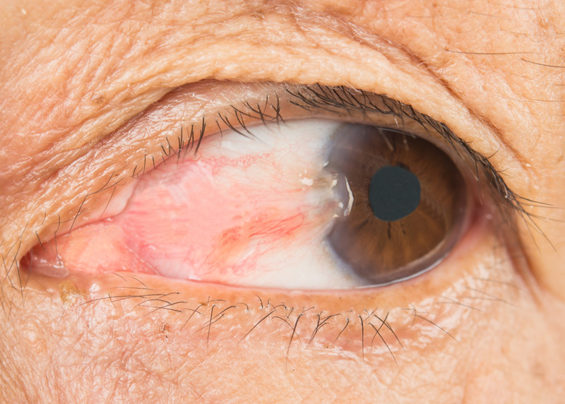 Pterygium is a raised fleshy growth on your cornea that contains many blood vessels.