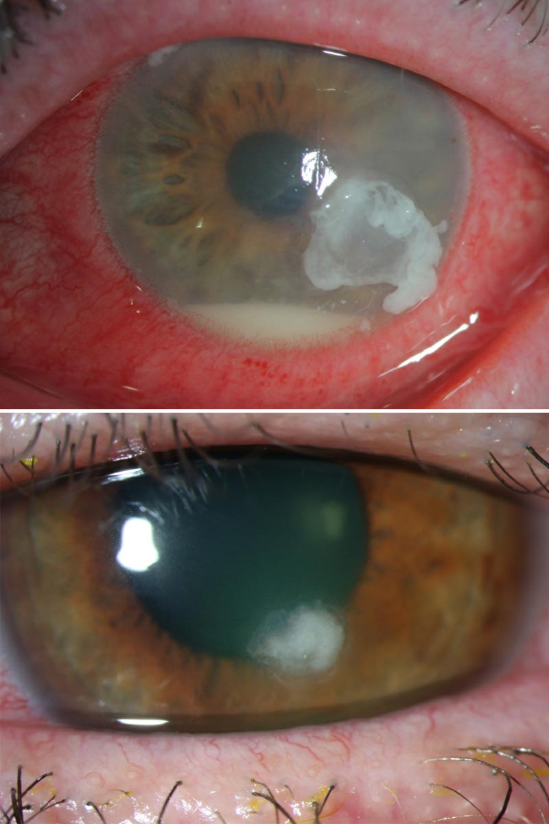 A corneal ulcer appears as white, hazy spots on the eye.