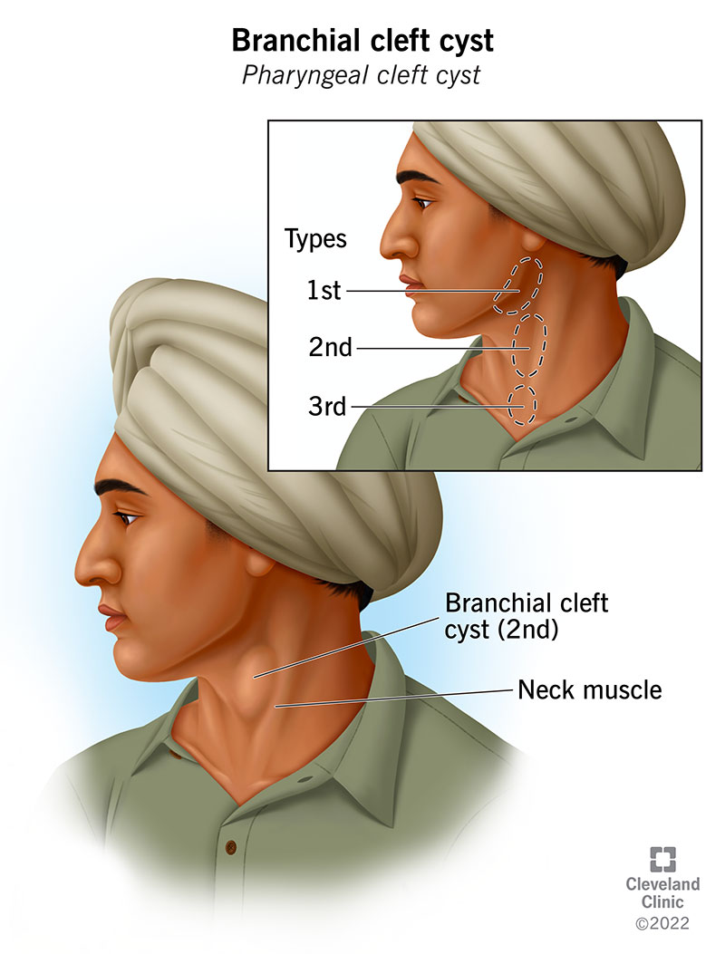 Lower: 2nd branchial cleft cyst under neck muscle skin. Inset: three branchial cleft cysts in jaw, neck and near collar bone.