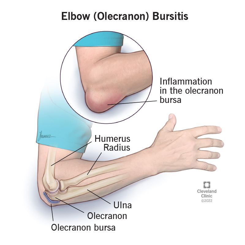 An inflamed olecranon bursa causes swelling on an elbow.