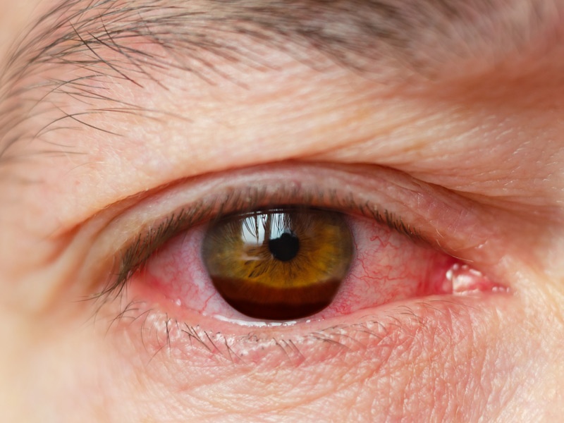 A hyphema causes blood to pool inside your eye.