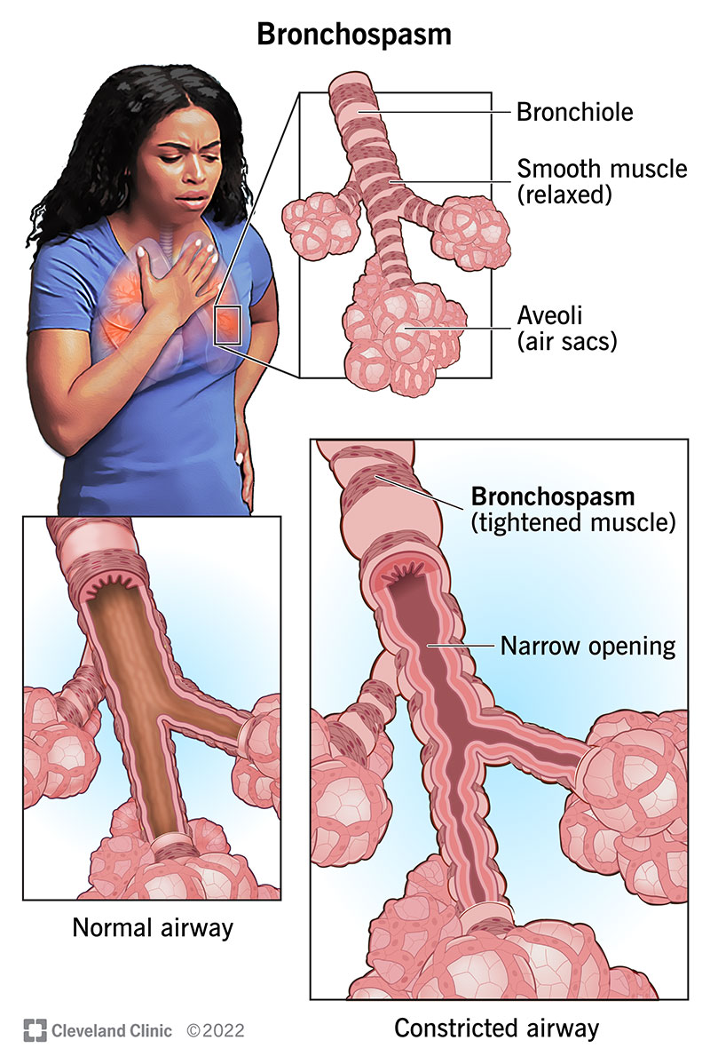 normal airway vs constricted airway affected by bronchospasm