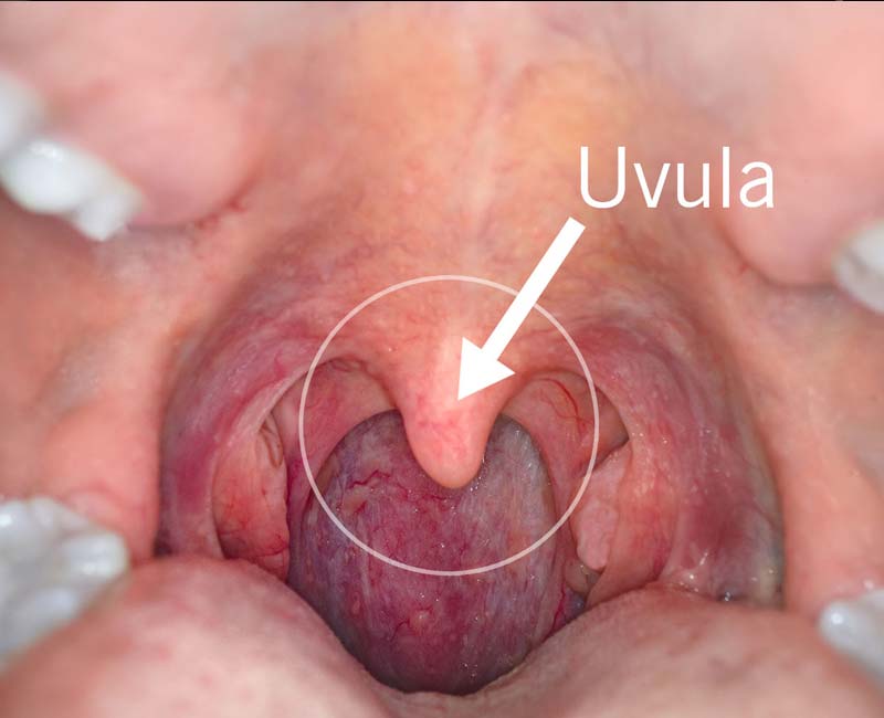 Arrow pointing to uvula in back of the throat
