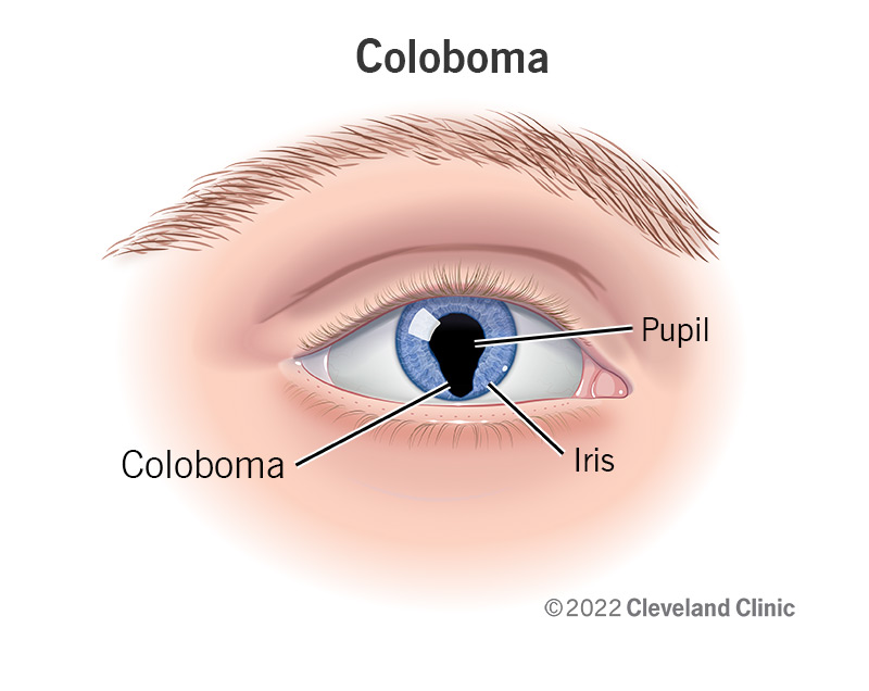 A coloboma in the iris of an eye.