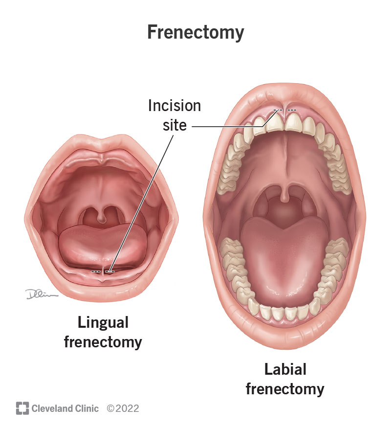 Incision sites for lingual and labial frenectomy. Lingual incision is under the tongue. Labial incision is under the upper lip.