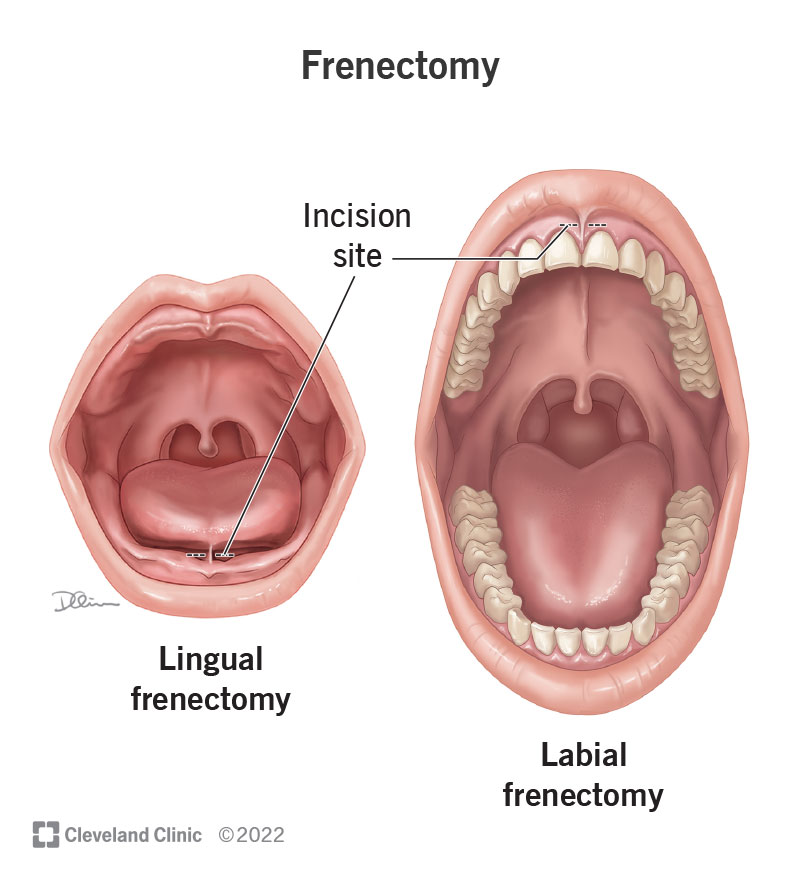 Frenectomy (Tongue-Tie Surgery): Procedure & Recovery