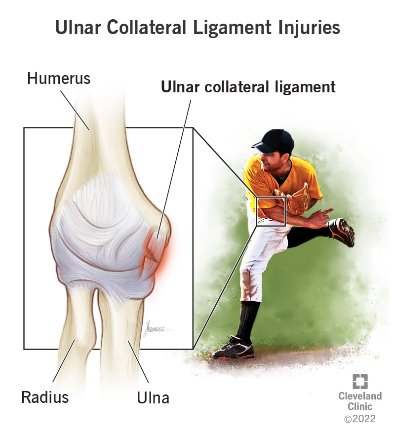 An ulnar collateral ligament injury labeled inside a baseball player's elbow.