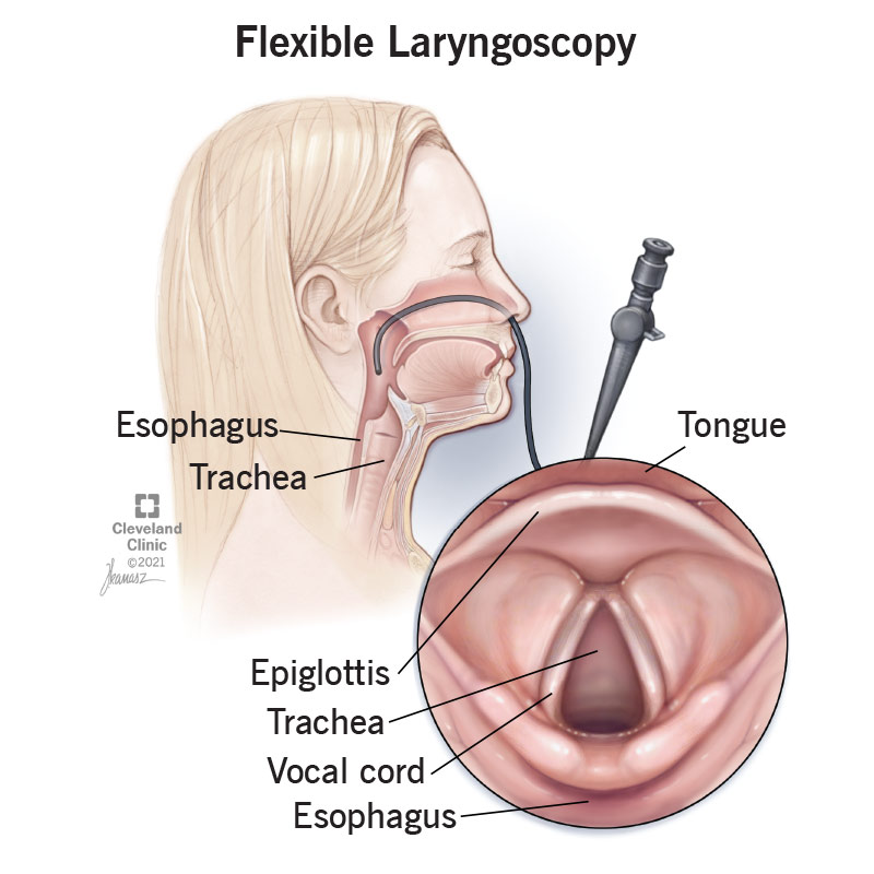 Woman receiving indirect nasal laryngoscopy with tube descending from nose to esophagus & trachea interior view of test area.