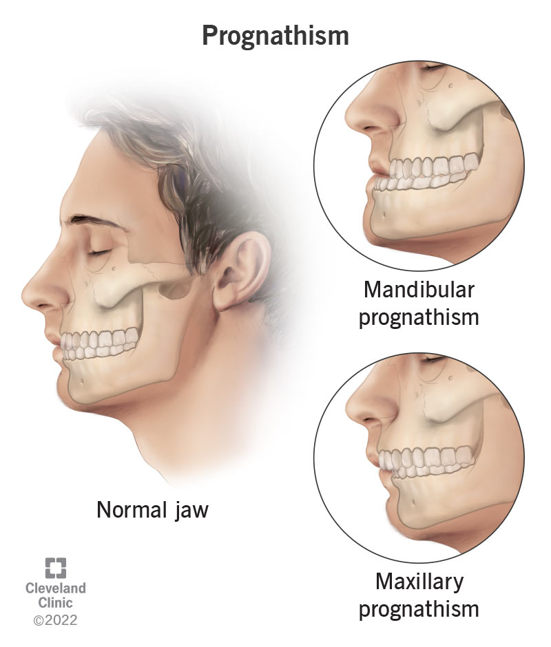 Prognathism, or protrusion of the lower jaw.
