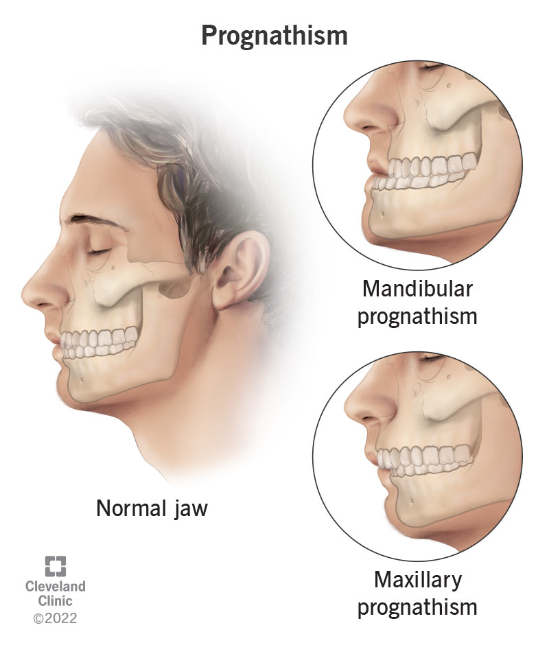 Prognathism: Definition, Causes & Treatment