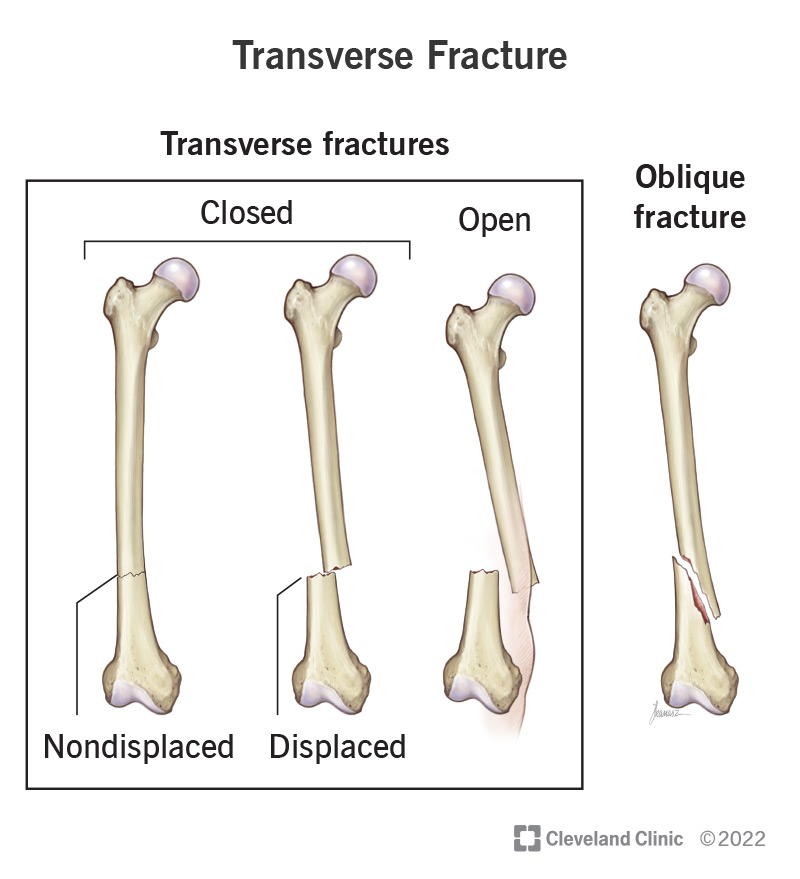 Illustrated comparison of transverse fractures that are open and closed, and displaced and non-displaced.