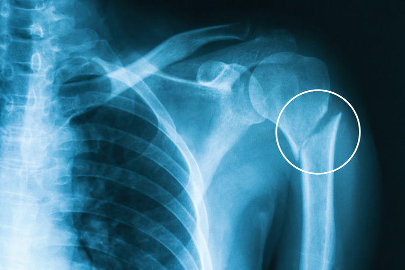 An X-ray of a proximal humerus fracture