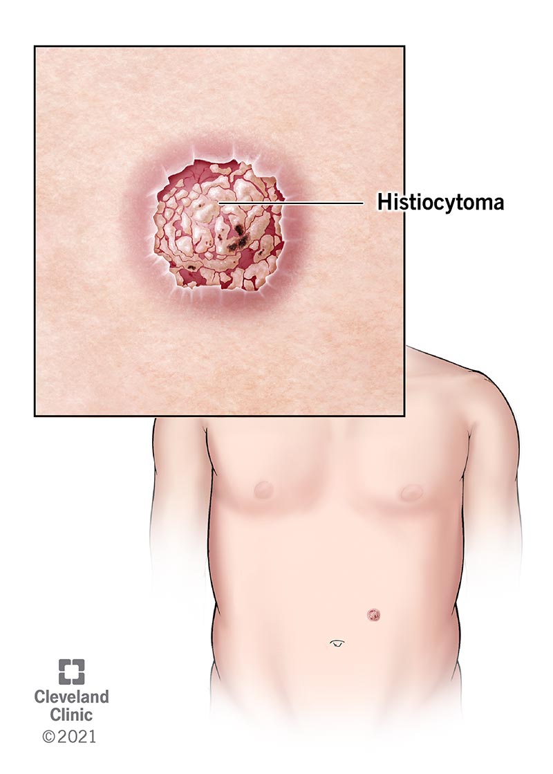 Human body showing where histiocytoma may occur.