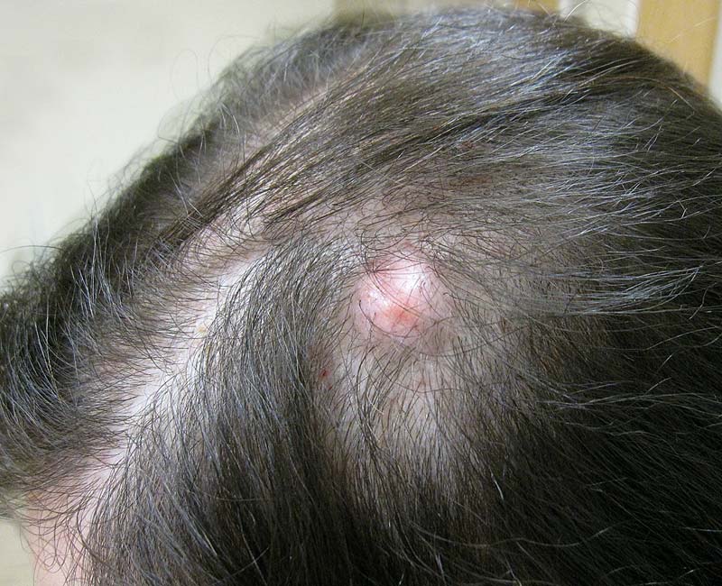 Pilar (trichilemmal) cysts are common fluid-filled growths (cysts) that form from hair follicles.