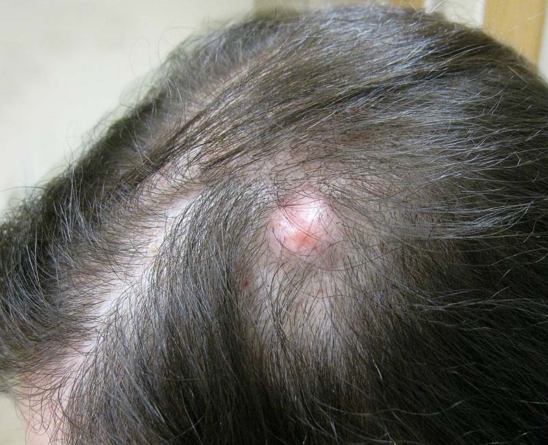 ingrown hair on back of head