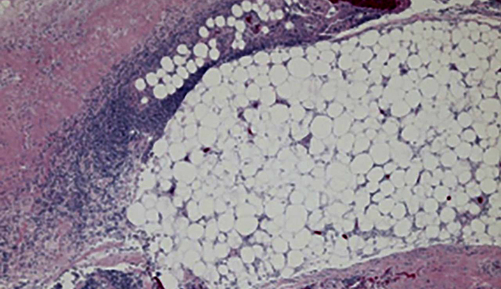 Microscopic view of necrosis of deep dermis, subcutaneous fat and fascial tissue with polymorphonuclear cell infiltration