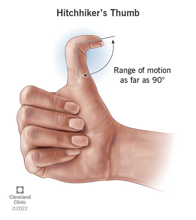 Hitchhiker's Thumb (Distal Hyperextensibility): Symptoms, Causes & Outlook