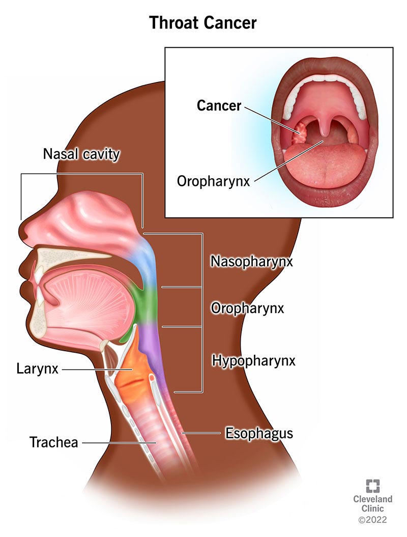 Side view of throat - Top to bottom nasal cavity, nasopharynx, oropharynx, larynx, hypopharynx, esophagus and trachea. Inset upper right - (Top left) Cancer tumor. Center Oropharynx