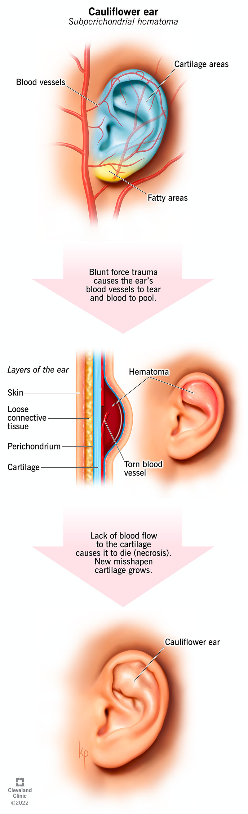 Flow chart showing how blunt force trauma leads to cauliflower ear.