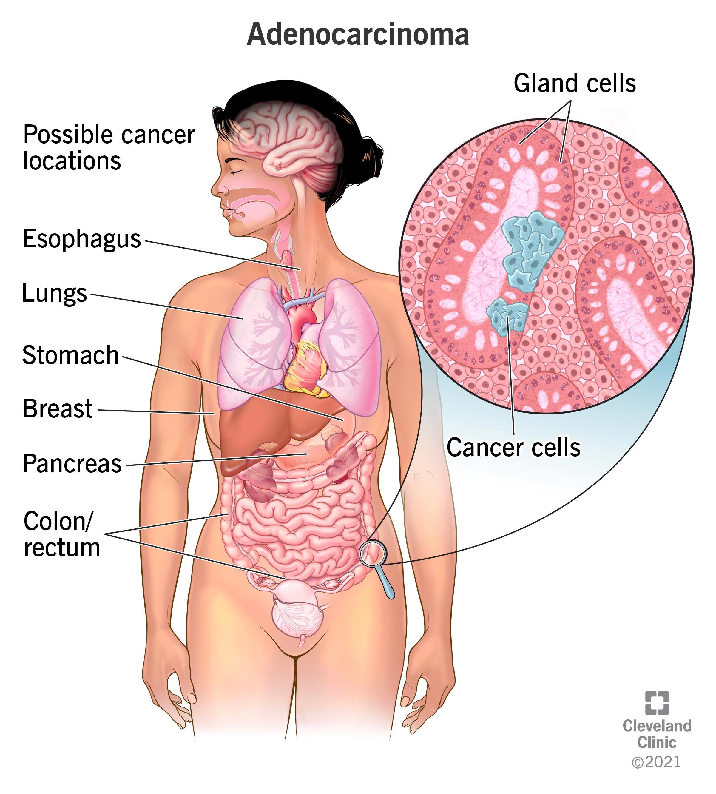 Cancer cells forming in the glandular epithelial cells lining the colon.