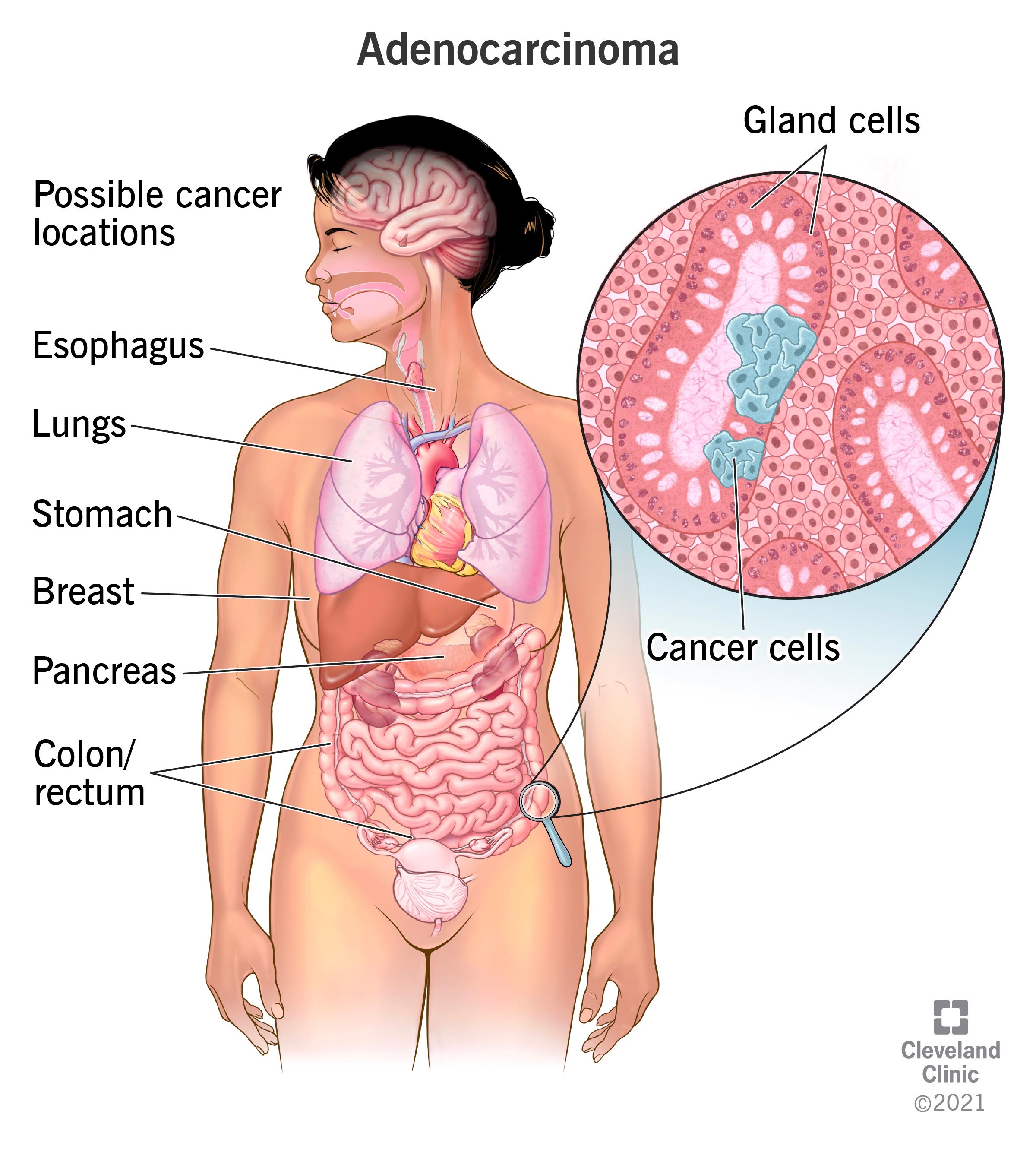 cancer cells diagram