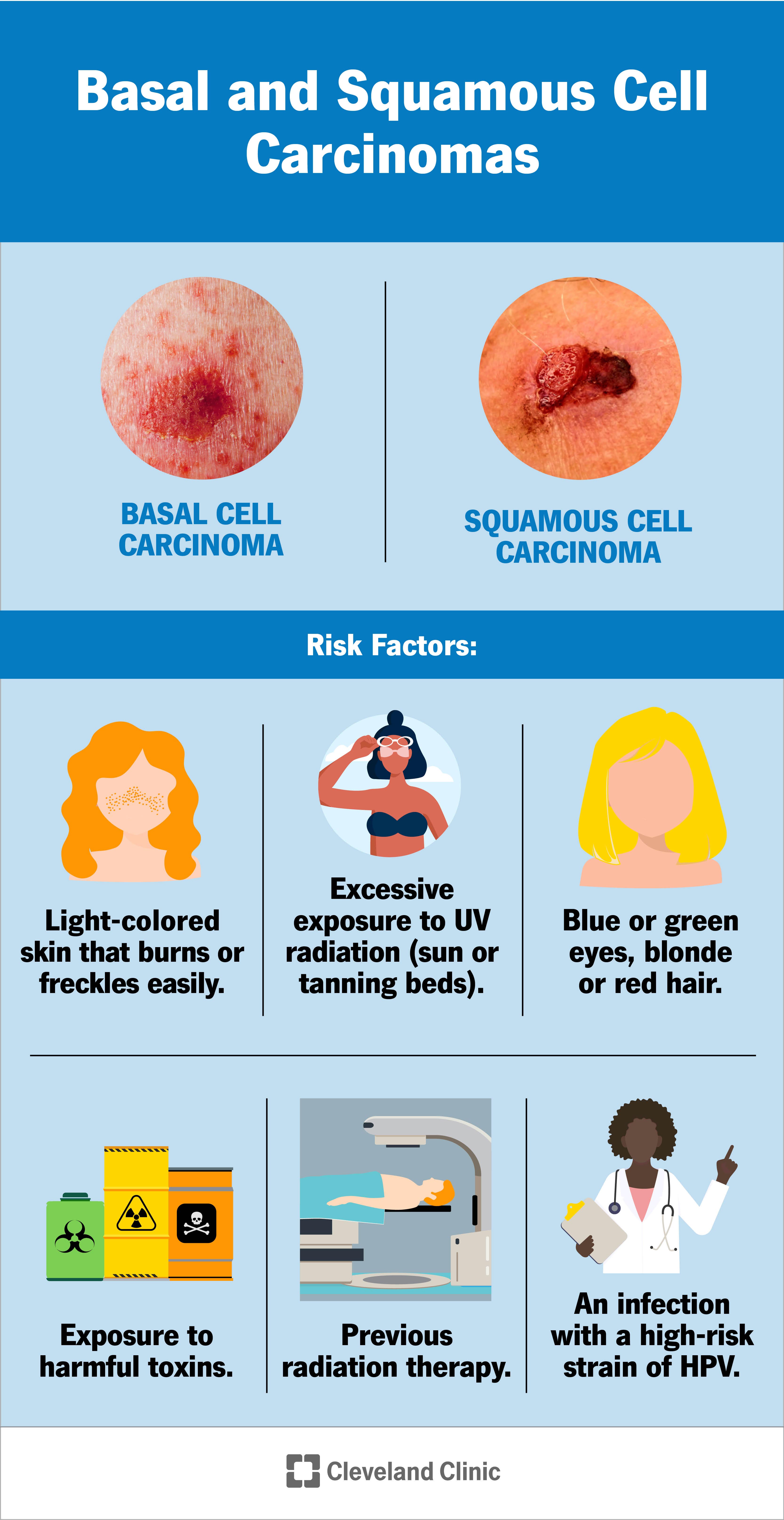 Risk factors for basal and squamous cell carcinoma include excessive exposure to UV radiation, light-colored skin that burns or freckles easily, blue or green eyes, blonde or red hair, an infection with a high-risk strain of HPV, previous radiation therapy and exposure to harmful toxins.