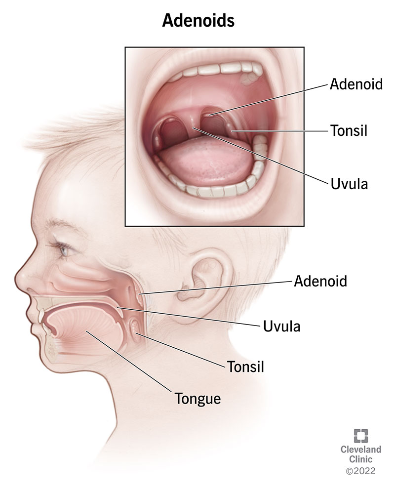 Cross section and direct view of adenoids in a young child.
