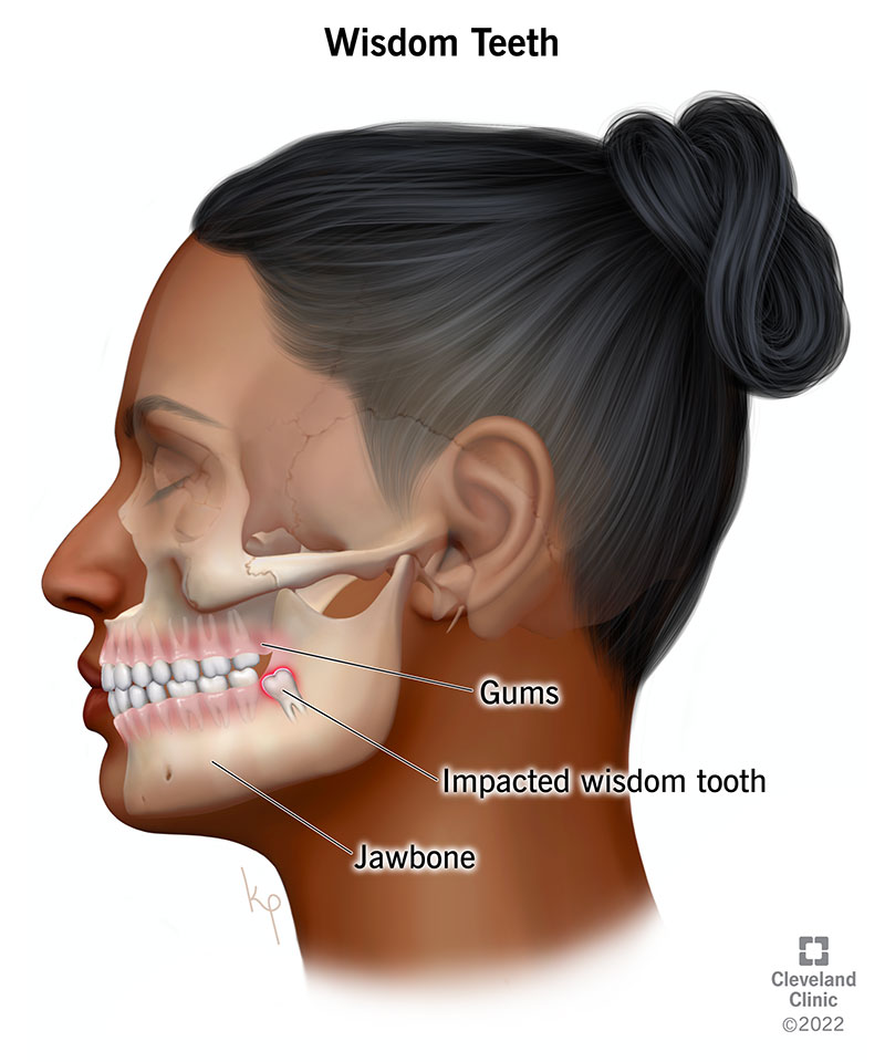 wisdom teeth food list