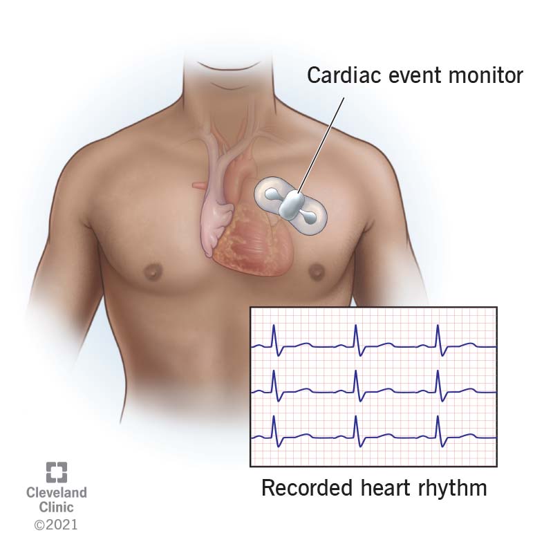 Cardiac event monitor placement to record heart activity.