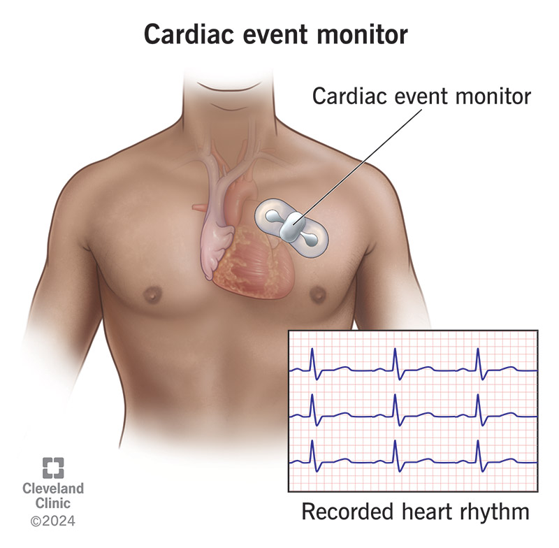 Cardiac event monitor placement to record heart activity.