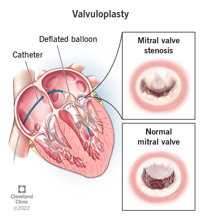 During a valvuloplasty, a surgeon guides a catheter with a deflated balloon to your narrowed heart valve and then inflates the balloon to open the narrowed valve.