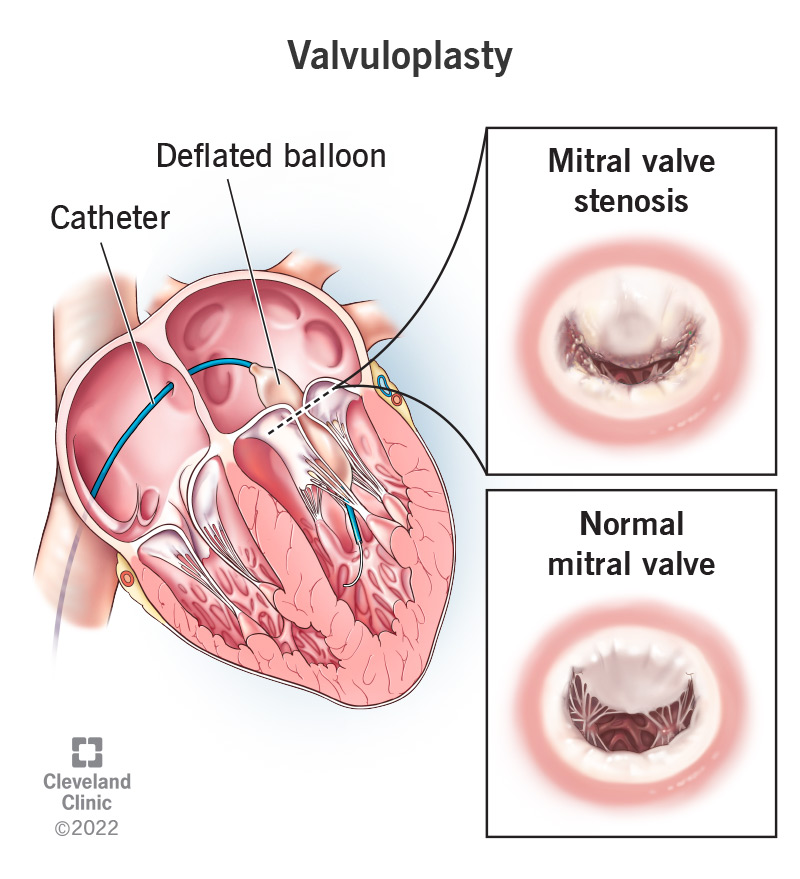 mitral valve stenosis