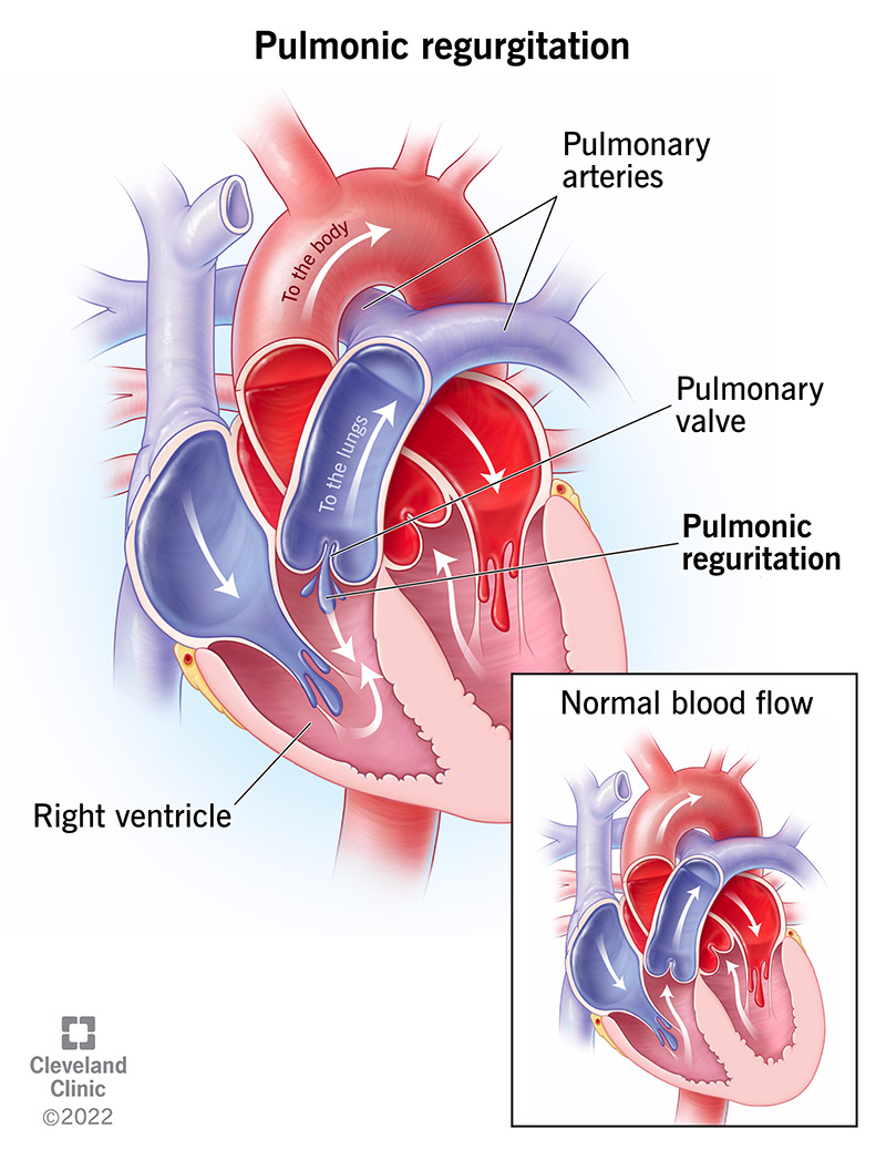 Pulmonic regurgitation is when blood leaks backward through the pulmonary valve, putting too much pressure on the heart.