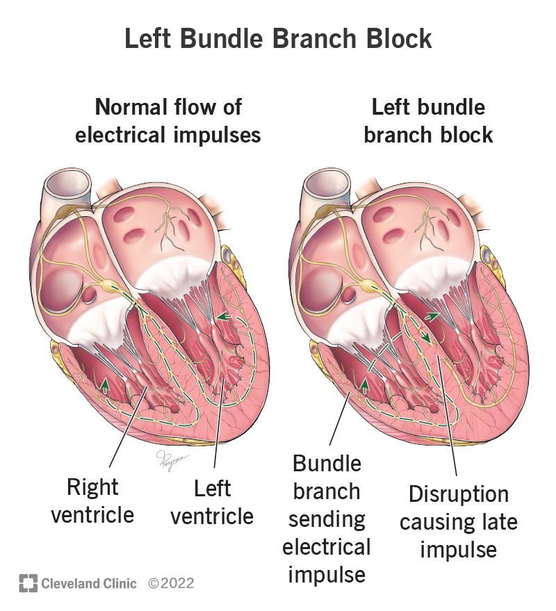 In left bundle branch block, there’s a disruption in the flow of electrical impulses through your heart.
