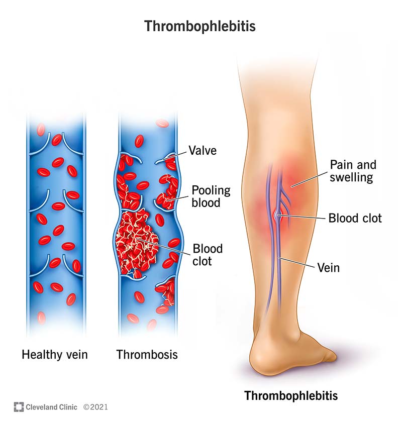 Swelling and pain in your lower leg are key signs of thrombophlebitis, which is blood vessel inflammation from a blood clot.