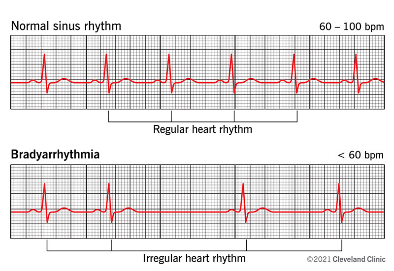 Abnormalities in Rate and Rhythm of Breathing Normal