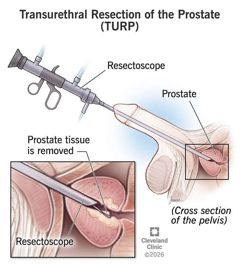 During transurethral resection of the prostate, the resectoscope enters your urethra and a laser or current removes tissue
