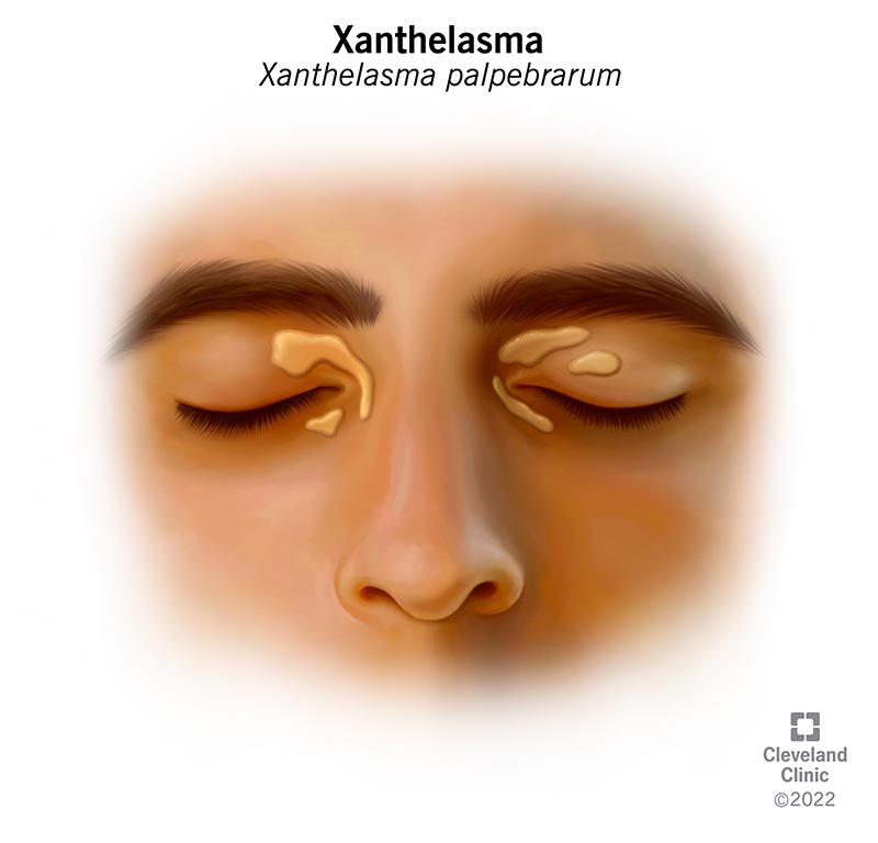 Xanthelasma (cholesterol deposits) under the skin around the eyes.