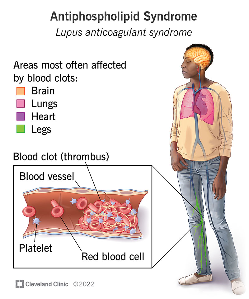 23430 Lupus Anticoagulant