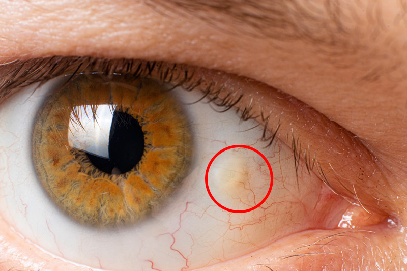 A pinguecula is yellowish patch or bump on the white of your eye.