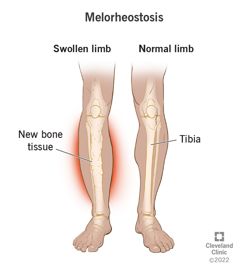 An illustration of melorheostosis affecting a tibia (shin bone)