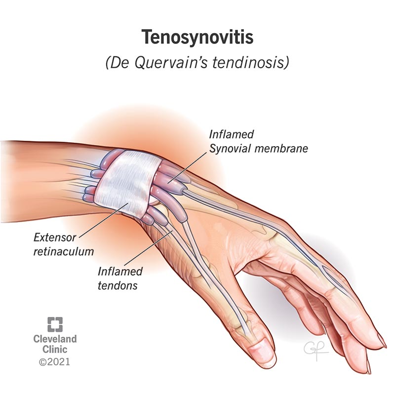 styloid process of radius pain