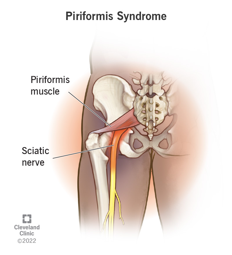 Piriformis syndrome labeled in a leg.